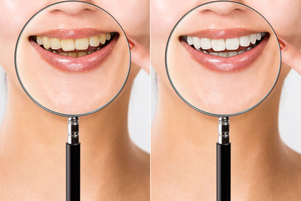 美容歯科の自宅で始める手軽に簡単セルフホワイトニング！『パールホワイトプロEXプラス』
